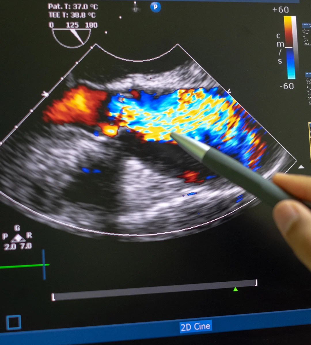 Vascular com Doppler